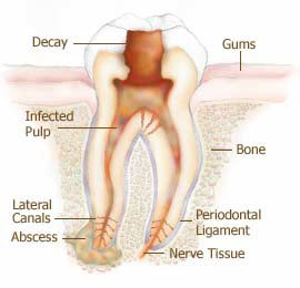 Painless Root Canals In Frisco TX
