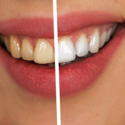 Frisco teeth whitening dentist shares bleachorexia horror story