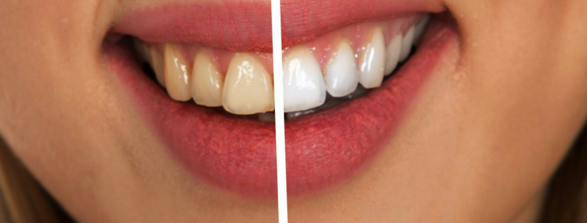 Frisco teeth whitening dentist shares bleachorexia horror story