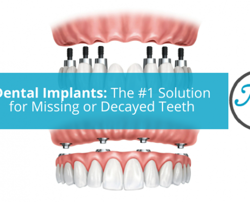 Dental Implants The Best Solution for Missing Teeth New Smiles Frisco