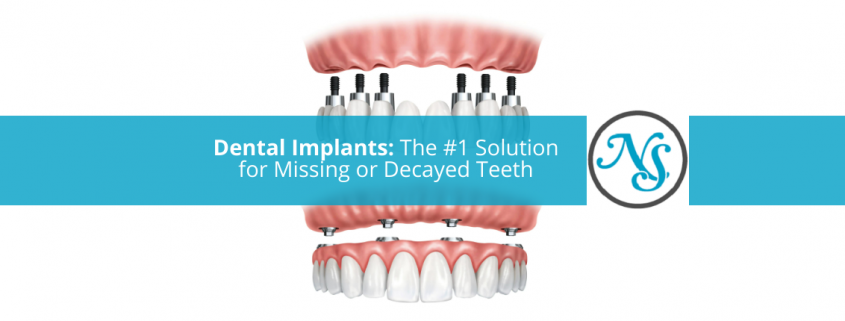 Dental Implants The Best Solution for Missing Teeth New Smiles Frisco