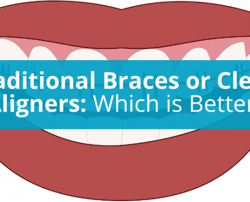 Traditional Braces or Clear Aligners- Which is Better